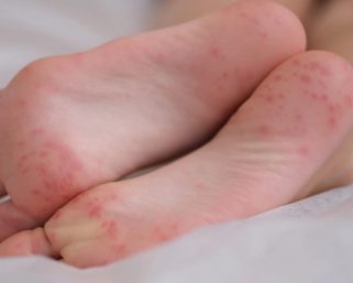 Secretaría de Salud de Armenia refuerza controles ante brote del síndrome de boca, manos y pies en jardines infantiles