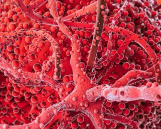 Una investigación concluyó que tener triglicéridos elevados puede contribuir a la aparición de aneurismas en la aorta abdominal